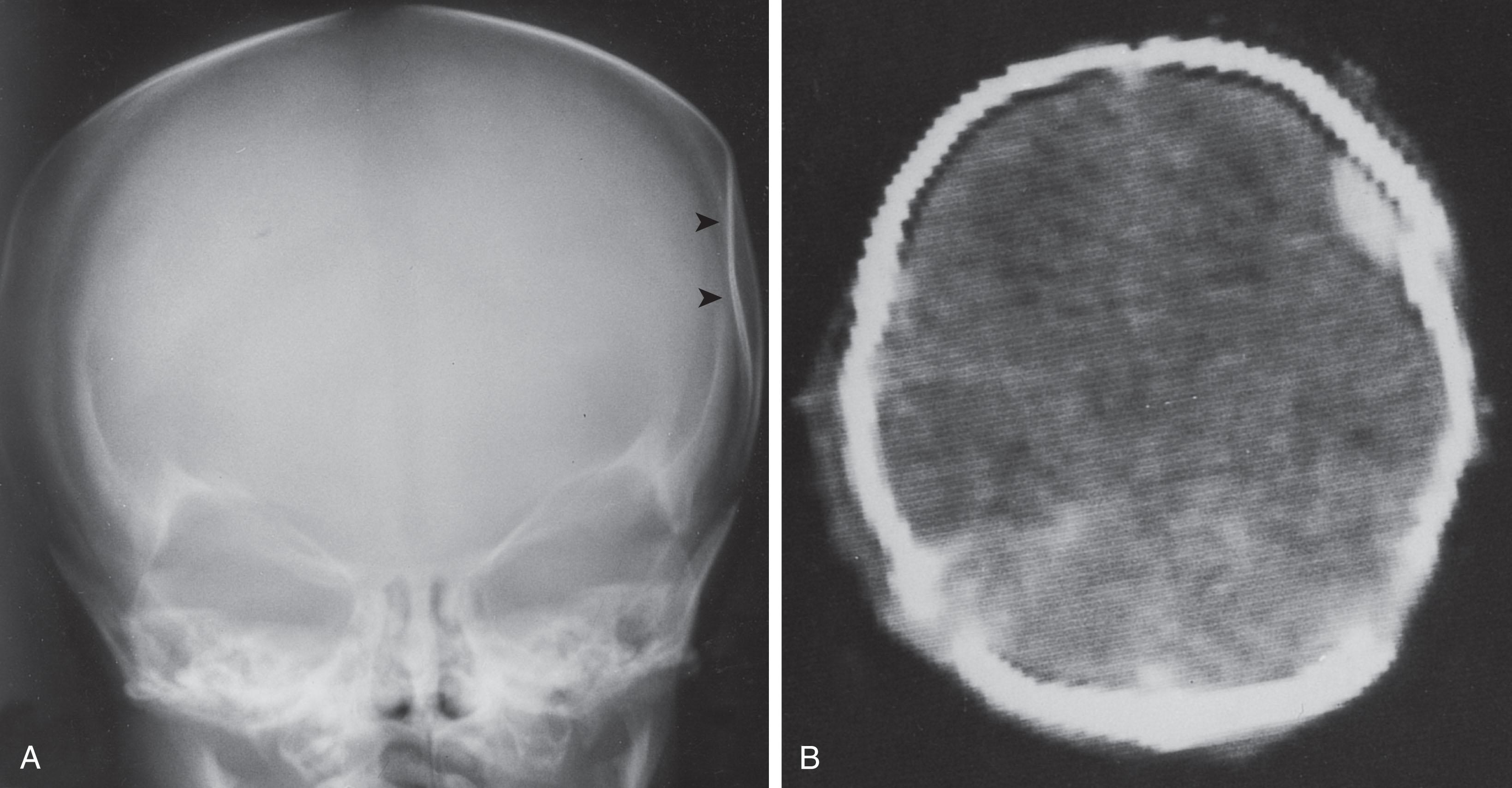 Fig. 40.6, Depressed skull fracture: x-ray and CT. (A) Conventional skull x-ray showing the typical depressed, “ping-pong” fracture of the newborn ( arrowheads ). (B) CT scan from another infant showing a less common depressed “fracture” in which the right coronal suture has been disrupted, causing the parietal bone to be sharply depressed. There is an underlying small epidural hematoma that exhibits the characteristic convex configuration.