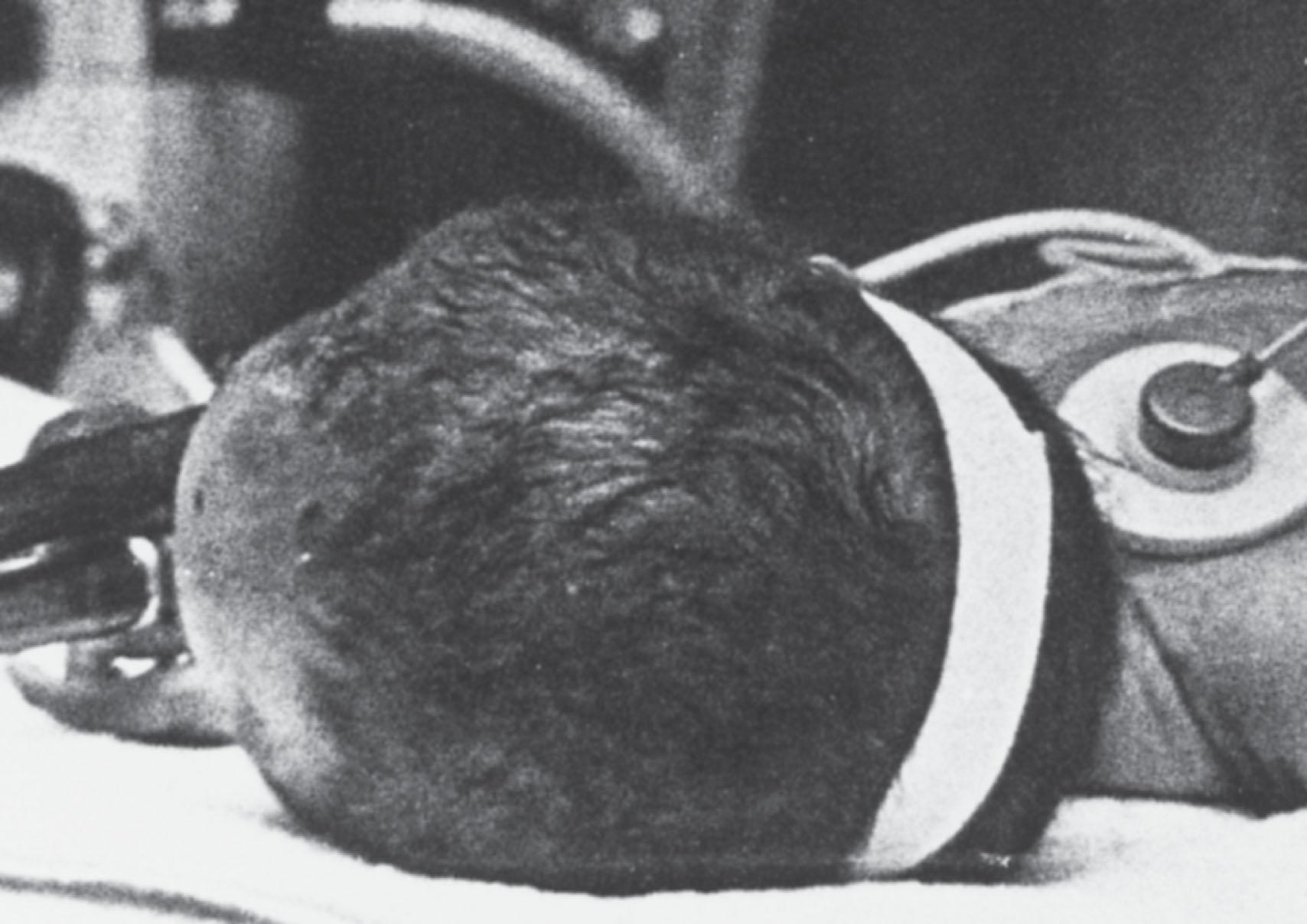 Fig. 40.7, Depressed skull fracture: clinical appearance. From an infant with the typical “ping-pong” fracture shown in Fig. 40.6 A. Note the depression in the right parietal region.