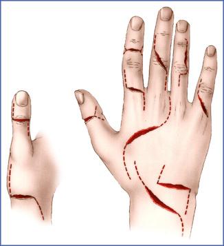 Fig. 11.11, Approaches to Extensor Apparatus