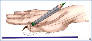 Fig. 11.4, Test of Extensor Pollicis Longus.