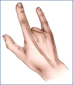 Fig. 11.6, Test of Index and Little Finger Extensors.