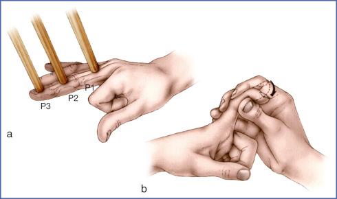 Fig. 11.7, Test of Extensor Digitorum Communis.