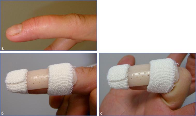 Fig. 11.8, Mallet Finger Treated by Dorsal Splint.