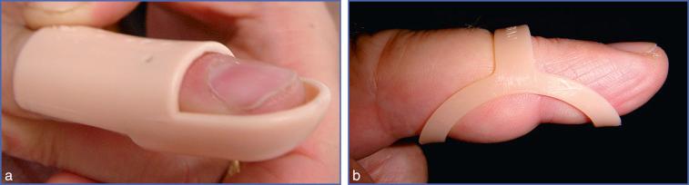 Fig. 11.9, Other Splints for Treating Mallet Finger.