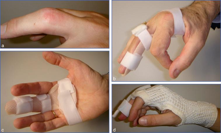 Fig. 11.10, (a) Subcutaneous rupture of the central slip (zone 3). (b, c) Static day palmar orthosis: MCP joint in 30 degrees of flexion, PIP and DIP joints in full extension. (d) Extension orthosis with a Levame blade to be worn at night.