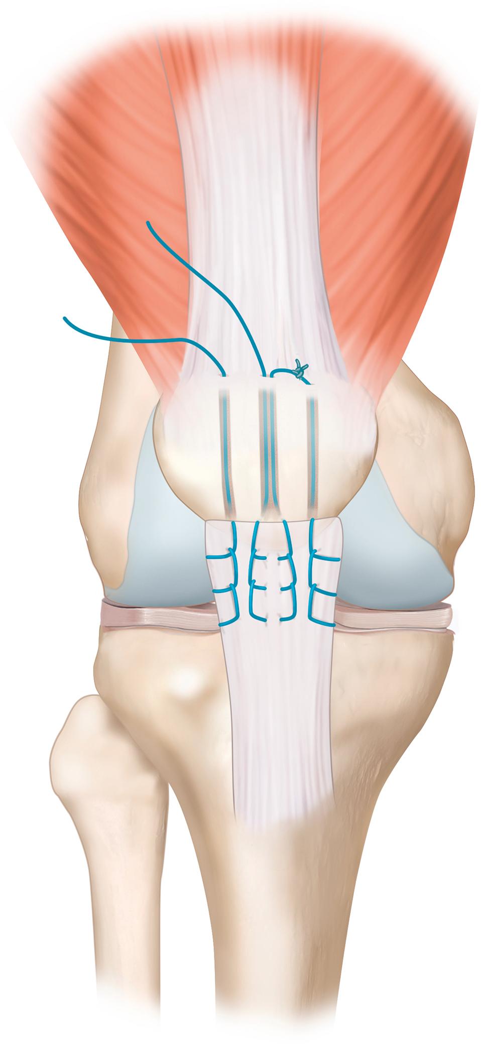 Fig. 33.3, Transosseous reattachment of a proximal patellar tendon rupture to the patella in a right knee.