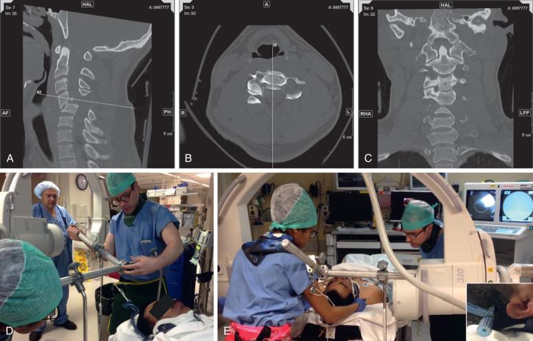 Figure 29.2, Closed reduction of C4–C5 fracture dislocation in incomplete cervical spinal cord injury. (a) Sagittal CT shows unstable C4–C5 fracture dislocation with significant distortion of the spinal canal. (b) Axial views demonstrate associated bilateral locked facets and “naked facet sign.” (c) Coronal view of the craniocervical junction. On physical examination, the patient has preserved sacral sensation and flicker of movement in the lower extremities consistent with an incomplete injury. The decision is made to initiate closed reduction by traction (D–E) in this awake and cooperative patient. Experienced providers reduce traction using Gardener Wells tongs, with careful placement of pins into the temporal bone above the ears (D insert). Anesthesia team assists with sedation, and fluoroscopy is set up. A 5-pound weight is applied at 5- to 10-minute intervals with the goal of 10 pounds for the skull and 5 pounds for each level of cervical spine above the injury. After adding extra weight, the patient is examined for neurologic change, and a lateral plain film is obtained to evaluate the dislocation and possible reduction (F). The patient is successfully reduced and maintained at 20 pounds of weight (G–H). T2WI of the cervical spine shows evidence of cord injury with intrinsic signal abnormality without epidural hematoma or compressive discoligamentous complex (I–J). Upright plain film demonstrates mechanical stability and restoration of cervical alignment following C4–C5 Anterior cervical discectomy and fusion (ACDF) and posterior spinal instrumented fusion (PSIF) (K).