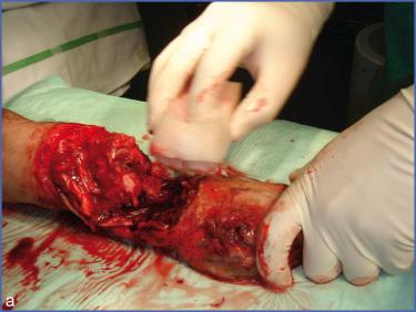 Fig. 4.1, Forearm Crushed by a Van.