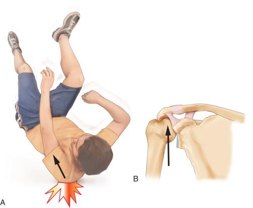 Fig. 56.6, Mechanism of acromioclavicular joint injury.