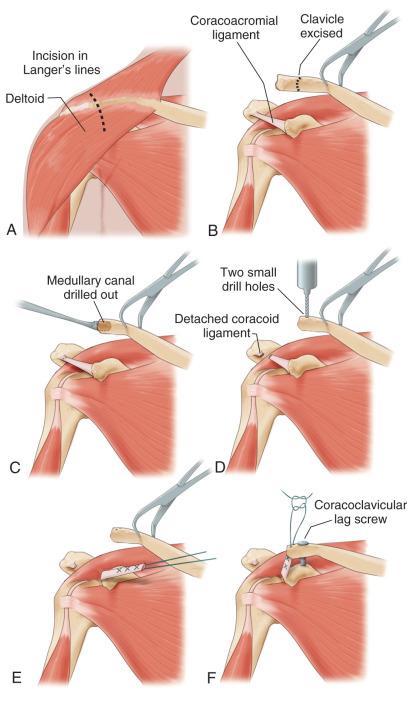 Fig. 56.16, Dr. Charles Rockwood's method of reconstructing a chronic type III, IV, V, or VI acromioclavicular dislocation.