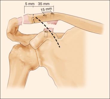 Fig. 56.18, Distances for the distal clavicle excision and bone tunnels are shown.