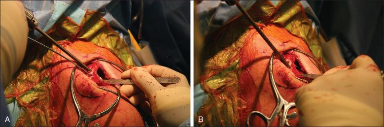 Fig. 56.21, After tunnel reaming of the conoid (A) and trapezoid (B) tunnels, copious irrigation is performed to remove any bone fragments.