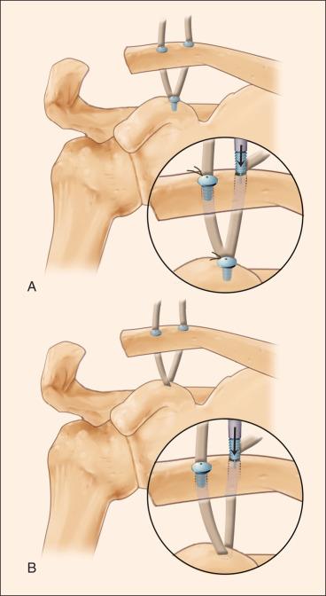 Fig. 56.23, (A) Fixation of the conoid and trapezoid graft limbs to the reduced clavicle using Biotenodesis screw (Arthrex Inc.) fixation. One limb of the biologic graft is taken and placed through the posterior bone tunnel, re-creating the conoid ligament. The other limb is passed through the anterior bone tunnel, recreating the trapezoid ligament. (B) As an alternative to a screw in the coracoid, we prefer that the graft be placed under the base of the coracoid.