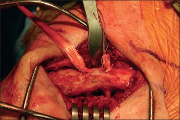 Fig. 56.24, A limb of no. 2 FiberWire (Arthrex Inc.) is also brought out each of the respective bone tunnels with the soft tissue graft. For reduction purposes, superiorly directed displacement of the scapulohumeral complex by the assistant reduces the acromioclavicular (AC) joint. Likewise, large point-of-reduction forceps placed on the coracoid process and the clavicle can further help with reduction while securing the tendon grafts. With the AC joint anatomically reduced and with the tendon graft sufficiently taut, a 5.5 mm polyetheretherketone (PEEK) interference screw is placed in either the posterior or midline bone tunnel. A no. 2 high-strength suture or FiberTape (Arthrex Inc.) is brought up through this cannulated screw hole, and the second PEEK interference screw is placed in the remaining bone tunnel.