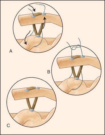 Fig. 56.25, (A and B) With both grafts secured using interference screw fixation, the no. 2 FiberWire (Arthrex Inc.) is tied over the top of the clavicle, becoming a nonbiologic fixation for the overreduced acromioclavicular joint. (C) Alternatively, we prefer that only the graft be used under the coracoid.