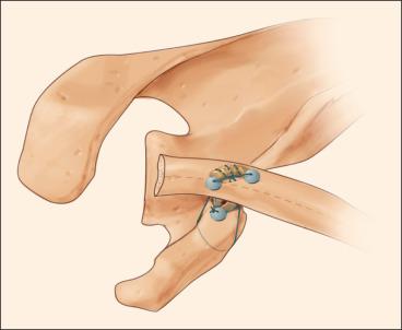 Fig. 56.26, The final view of the anatomic coracoclavicular ligament reconstruction.