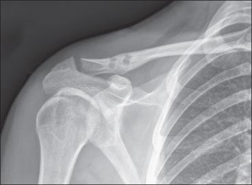 Fig. 56.27, A final anteroposterior radiograph demonstrating reduction of the acromioclavicular joint with the two 5.5-mm clavicular tunnels.