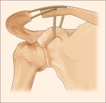 Fig. 56.28, A graft limb (usually the lateral trapezoid limb) may be brought out to the acromion to reconstruct the acromioclavicular joint capsule. This graft limb may be fed into the end of the acromion that articulates with the clavicle and then may exit out the top and return to the clavicle. Significantly less anterior, posterior, and superior translation has been reported with this acromial limb graft technique, which reportedly better reproduces the native joint. 16