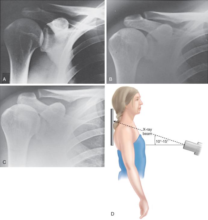 Fig. 56.8, An explanation of why the acromioclavicular (AC) joint is poorly visualized on routine shoulder radiographs. (A) This routine anteroposterior view of the shoulder shows the glenohumeral joint well. However, the AC joint is too dark to be interpreted because that area of the anatomy has been overpenetrated by the x-rays. (B) When the usual exposure for the shoulder films is decreased by two-thirds, the AC joint is well visualized. However, the inferior corner of the AC joint is superimposed on the acromion process. (C) Tilting the tube 15 degrees upward provides a clear view of the AC joint. (D) The position of the patient for the Zanca view: a 10- to 15-degree cephalic tilt of the x-ray tube is required to visualize the AC joint.