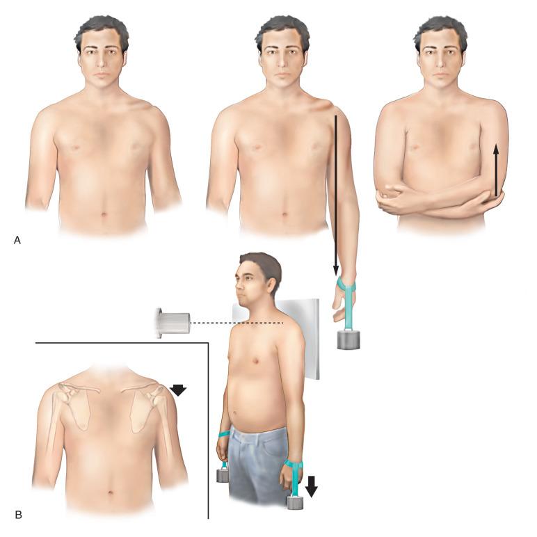 Fig. 56.9, The technique of obtaining stress radiographs of the acromioclavicular (AC) joint.