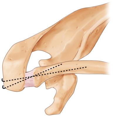 Fig. 56.15, Acromioclavicular ligament repair.