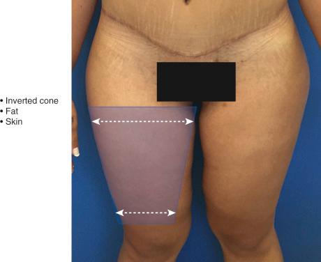 FIGURE 39.2, The ideal inverted cone shape of the thigh.