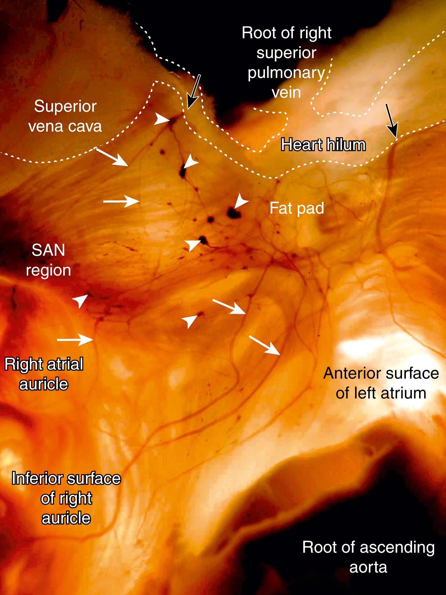 Fig. 38.3, Macrophotograph of the ventral surface of a newborn human heart histochemically stained for acetylcholinesterase, demonstrating the right ventral nerve subplexus associated with the sinoatrial node (SAN) region.