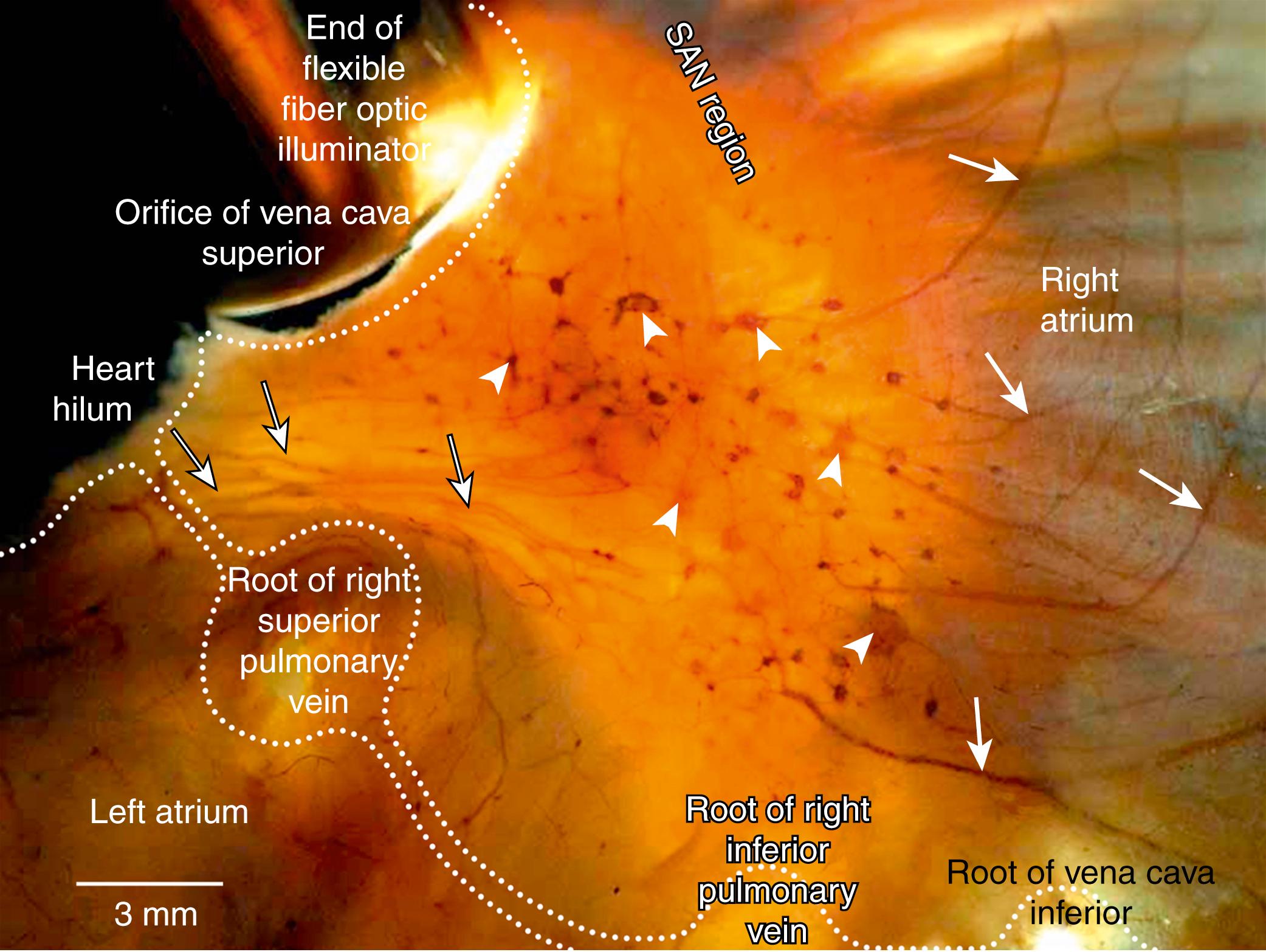 Fig. 38.4, Macrophotograph of the dorsal surface of a newborn human heart histochemically stained for acetylcholinesterase, demonstrating the dorsal right atrial nerve subplexus associated with the sinoatrial node (SAN) region.