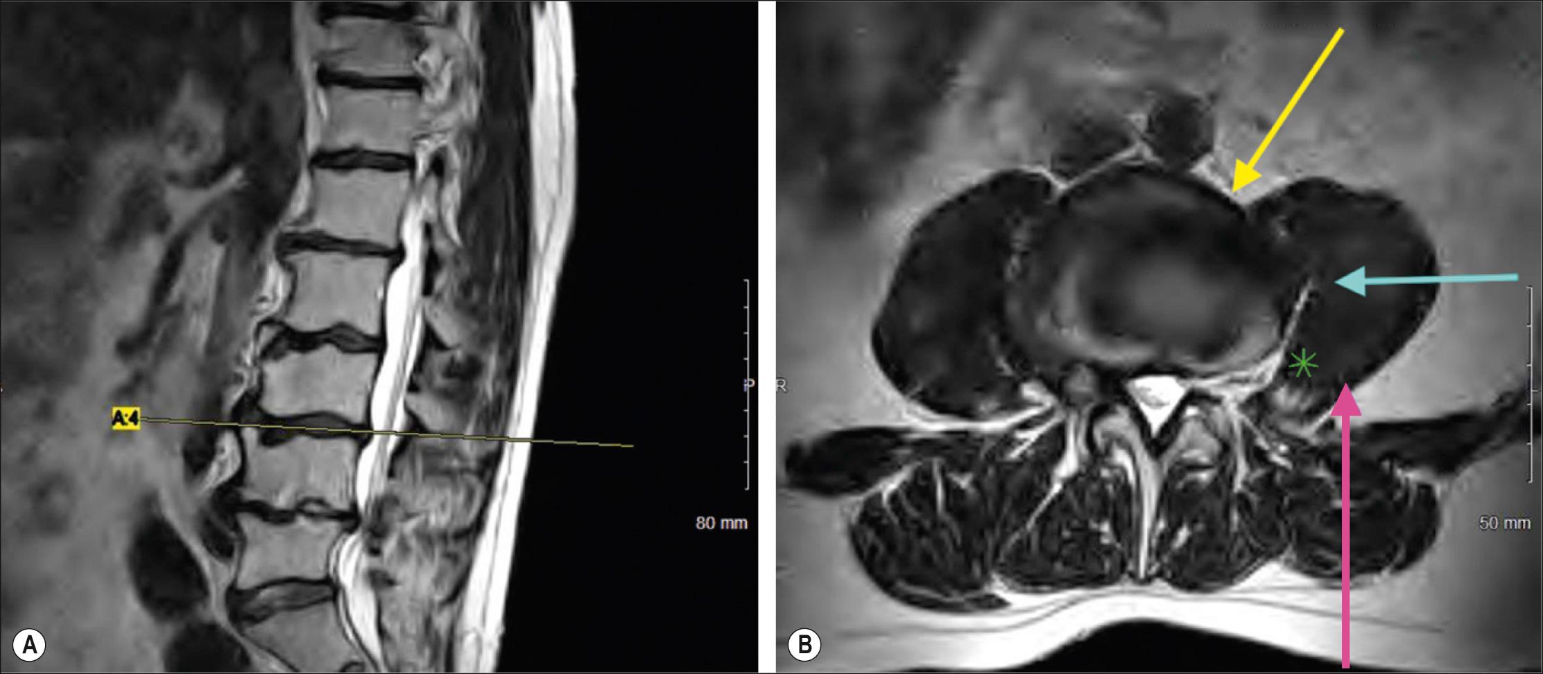 Fig. 78.1, Imaging of the lumbar spine. A , A lateral MRI. B , A corresponding axial T2-weighted MRI. The yellow arrow shows the operative trajectory that is typical for oblique lumbar interbody fusion, between the great vessels and psoas major. The teal arrow shows the trajectory of the transpsoas approach to the spine, which traverses psoas major and the lumbosacral plexus (LSP). The pink arrow demonstrates the trajectory of posterior or posterolateral approaches to the retroperitoneum and LSP. This is also the trajectory of the needle for lumbar plexus blockade. The green asterisk shows one of the branches of the lumbar plexus in the axial plane as it courses through psoas major.