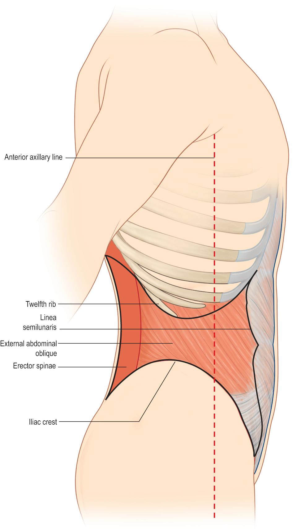 Fig. 78.2, A lateral view showing the pertinent superficial landmarks for lateral retroperitoneal exposure of the lumbosacral plexus. The boundaries of the lateral approach are the twelfth rib superiorly, the linea semilunaris ventrally, erector spinae posteriorly, and the iliac crest inferiorly. Note that retroperitoneal surgical exposure is typically performed posterior to the anterior axillary line.