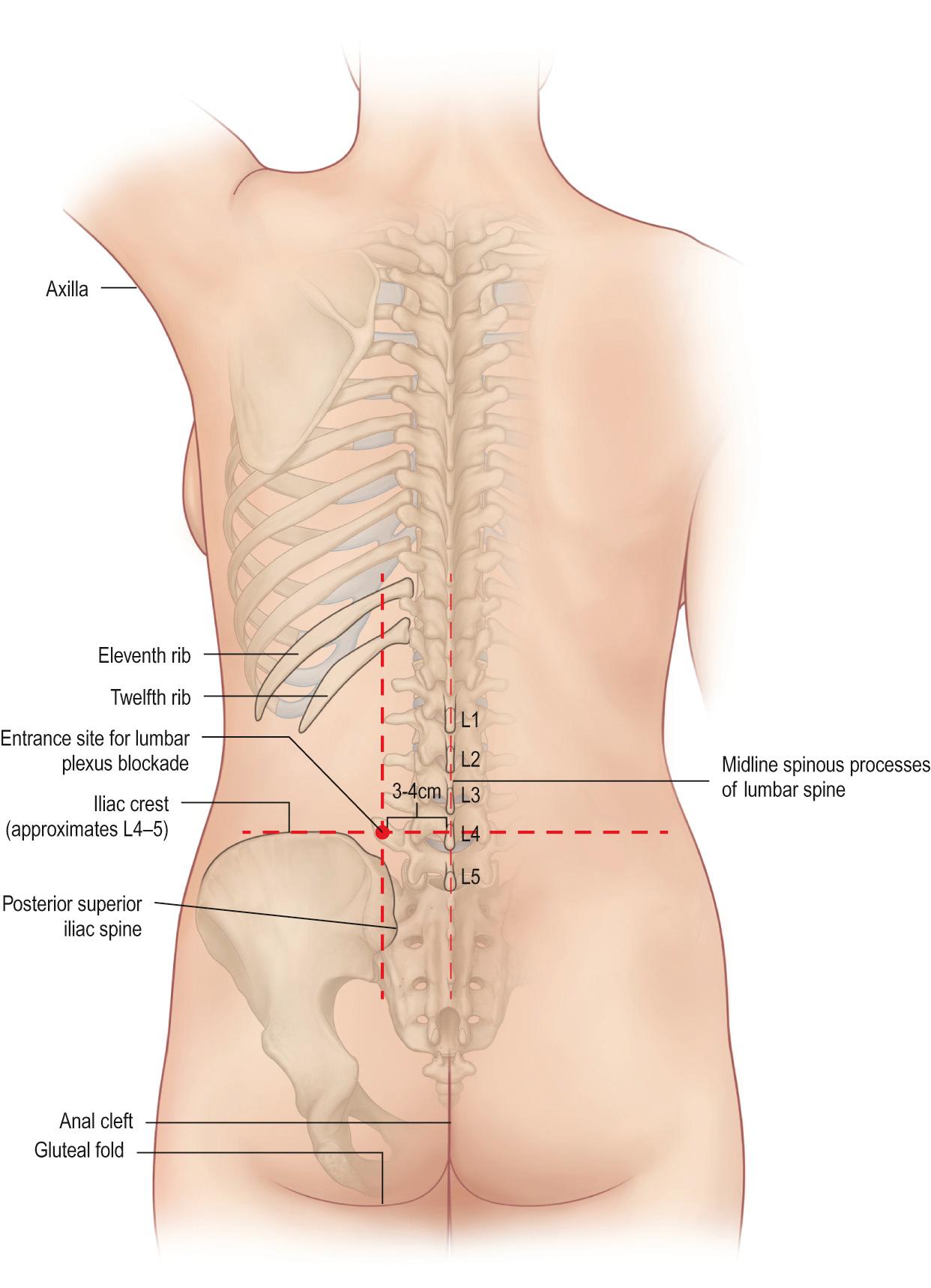 Fig. 78.3, A posterior view of the back, showing the surface landmarks for lumbar plexus blockade. The entry point is approximately 3–4 cm off the midline, perpendicular to a line connecting the iliac crest and the spinous processes of the lumbar spine. This is generally in the same plane as the posterior superior iliac spine from a medial to lateral standpoint.