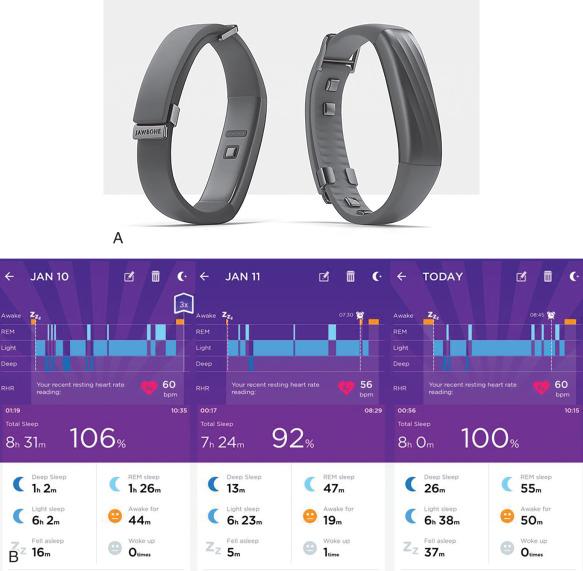 FIG. 75.2, (A) Jawbone UP3 wearable sleep tracking device. (B) Screen capture from 3 nights' duration of data is demonstrated. The device provides estimates of sleep based on actigraphy. Heart rate monitoring is included. Pulse oximetry is not included, as the collection of these data is restricted by federal regulatory controls.