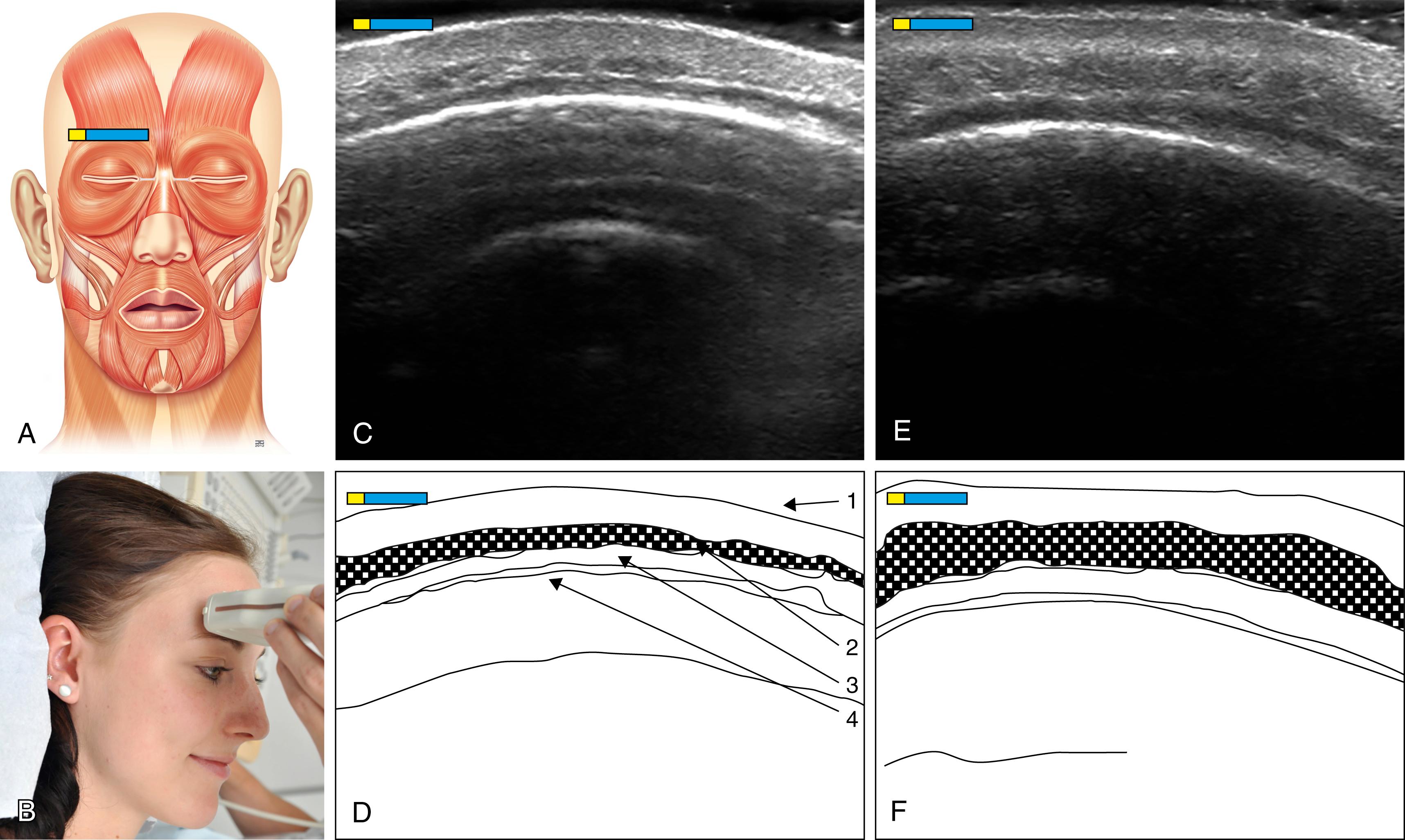 Fig. App.2, (A) Schematic representation of the mimic musculature with the marker over the venter frontalis, M. occipitofrontalis. (B) Photo, position of the ultrasound transducer cutting the venter frontalis. (C) Sonographic image of the venter frontalis in resting position. (D) Schematic representation of the venter frontalis in resting position: 1 outer skin; 2 venter frontalis, M. occipitofrontalis right side; 3 subaponeurotic/subgaleal displacement gap; 4 os frontale. (E) Sonographic image of the frontalis at maximum contraction. (F) Schematic representation of the M. frontalis at maximum contraction.