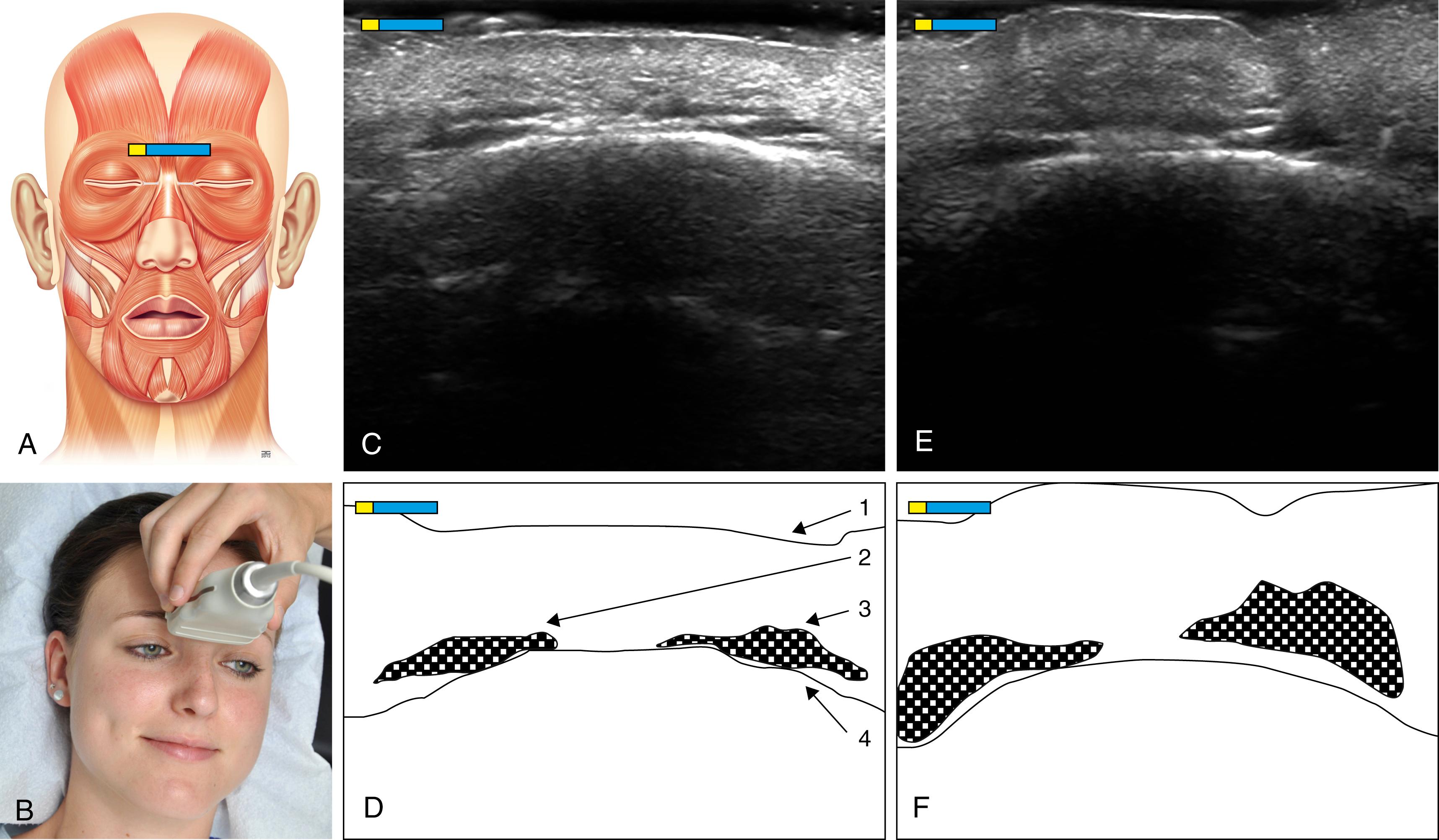 Fig. App.3, (A) Schematic representation of the mimic musculature with the marker over the right and left M. corrugator supercilii. (B) Photo, position of the ultrasound transducer cutting the M. corrugator supercilii. (C) Sonographic image of the M. corrugator supercilii in resting position. (D) Schematic representation of the corrugator supercilii in resting position: 1 outer skin; 2 M. corrugator supercilii right side; 3 M. corrugator supercilii left; 4 os frontale. (E) Sonographic image of the M. corrugator supercilii at maximum contraction. (F) Schematic representation of the M. corrugator supercilii at maximum contraction.