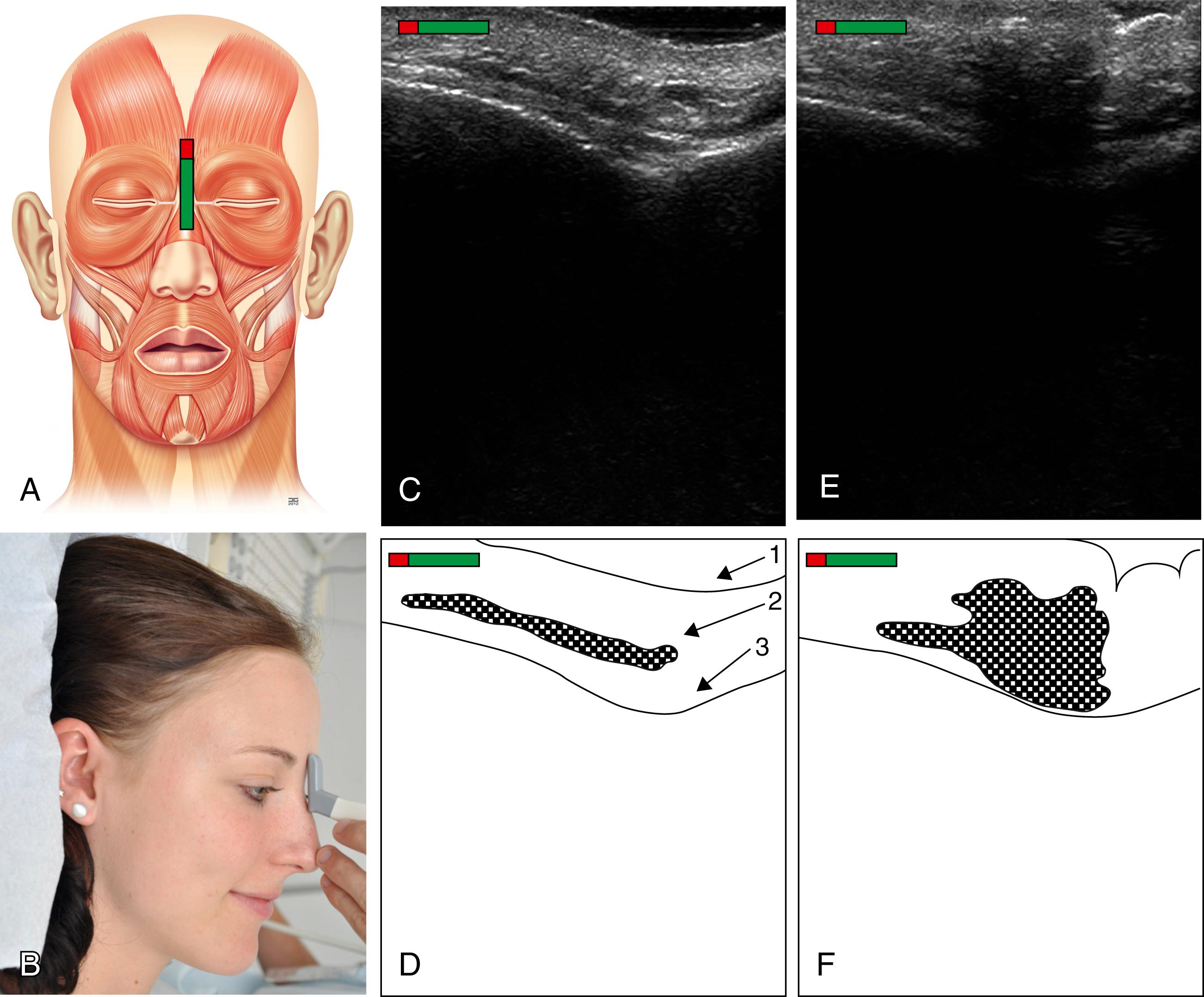 Fig. App.4, (A) Schematic representation of the mimic musculature with the marker over the M. procerus. (B) Photo, ultrasound transducer cutting the M. procerus. (C) Sonographic image of the M. procerus in resting position. (D) Schematic representation of the M. procerus in resting position: 1 outer skin; 2 M. procerus; 3 border of the os frontale and os nasale. (E) Sonographic image of the M. procerus at maximum contraction. (F) Schematic picture of the M. procerus at maximum contraction.