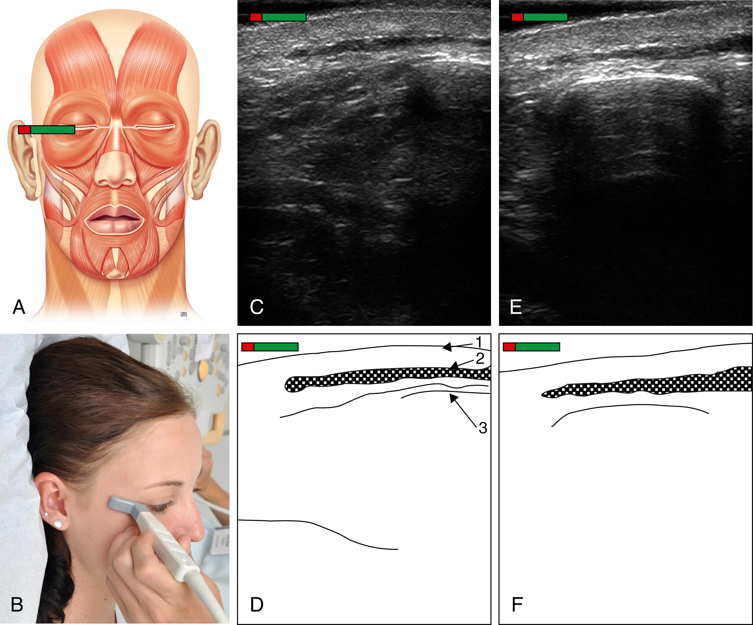 Fig. App.5, (A) Schematic representation of the mimic musculature with the marker over the pars orbitalis of the M. orbicularis oculi. (B) Photo, ultrasound transducer cutting the M. orbicularis oculi. (C) Sonographic image of the M. orbicularis oculi in resting position. (D) Schematic representation of the M. orbicularis oculi in resting position: 1 skin surface; 2 gate of M. orbicularis oculi; 3 border of the orbita. (E) Sonographic image of the M. orbicularis oculi at maximum contraction. (F) Schematic picture of the M. orbicularis oculi at maximum contraction.