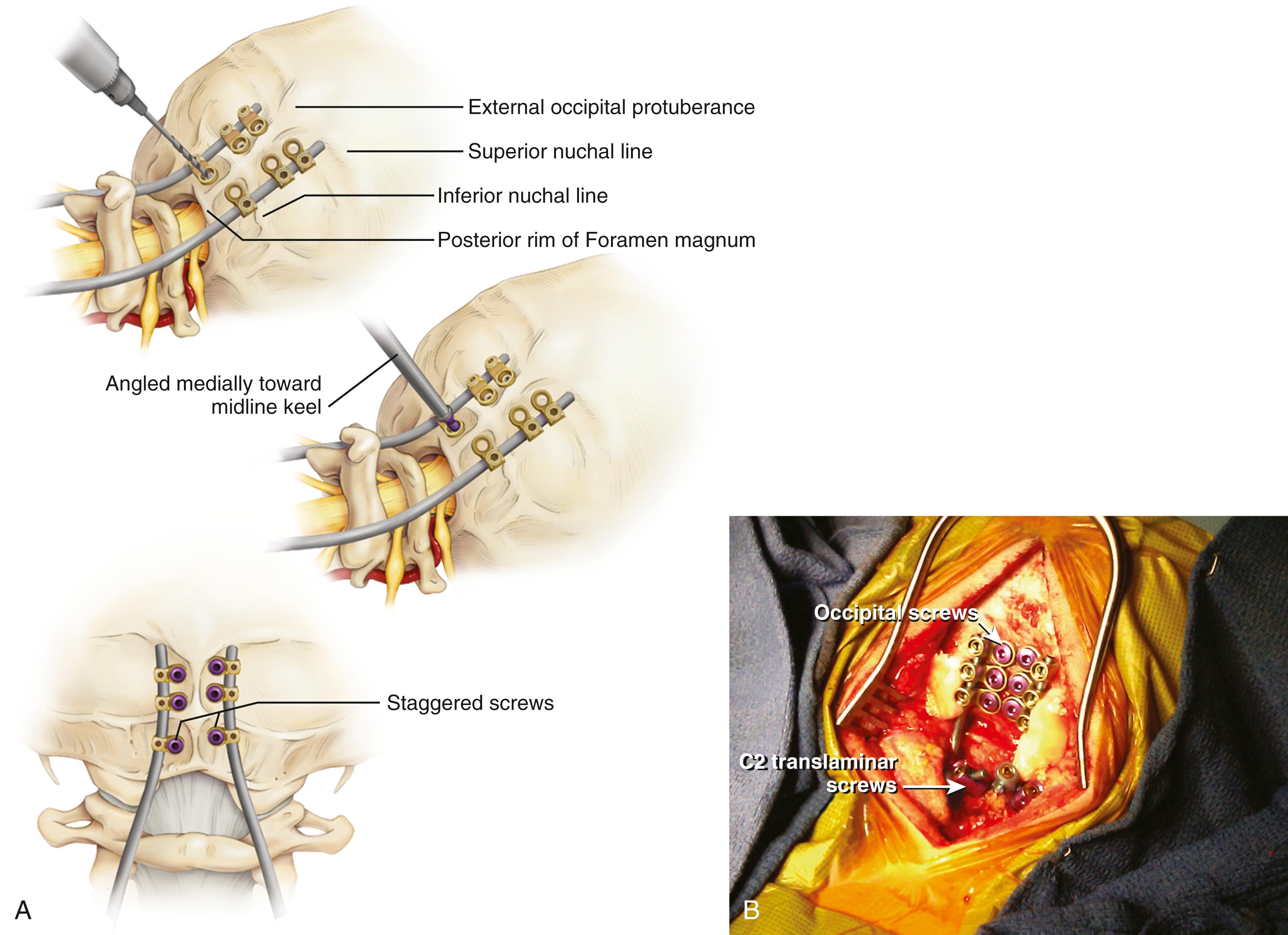 FIGURE 78.1, (A) Occipital screw technique. Prior to drilling, anatomic landmarks are identified. Four bony landmarks on the outer occipital cortex should be visible: the posterior rim of the foramen magnum, the superior nuchal line, the inferior nuchal line, and the external occipital protuberance. Safe placement of occipital instrumentation is placed between the inferior and superior nuchal line. 4.0 to 4.5 mm-diameter occipital screws may be placed in a bicortical fashion using the stop-drill, or step-wise drill, technique in 2 mm increments. Drill and screw trajectories should be angled medially toward the thick midline keel. Left and right occipital screws are staggered to avoid intersection of screw paths. (B) Intraoperative picture.