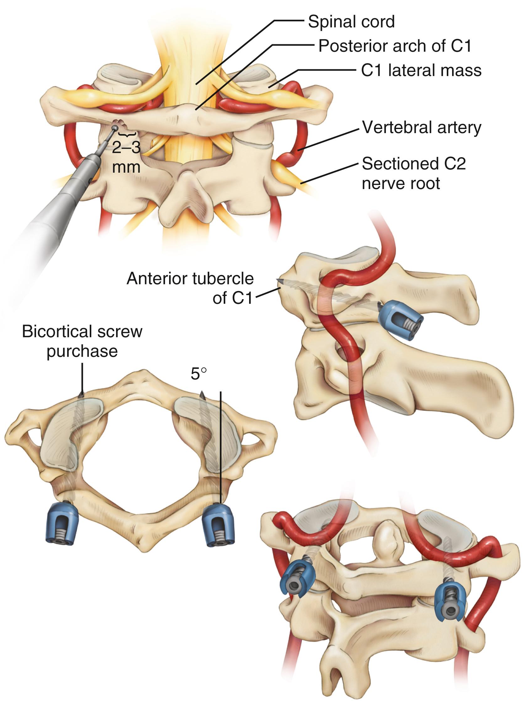 FIGURE 78.3, C1-2 transarticular screw technique. A midline incision is made to expose the posterior elements from C1 to C3 with particular attention paid to C2-3 facet joints. The superior and medial aspects of the C2 pars are exposed. There is no reason to expose the lateral aspect of the C2 pars; in fact, this may be a dangerous maneuver because of the proximity of the vertebral artery. The roof of the C2 pedicle is followed to the C1-2 facet joint. The C2 entry point may be identified by first locating the medial edge of the C2-3 facet joint. The C2 entry site is just lateral and rostral to this point and may be estimated by visualizing the course of the medial pars (approximately 3 mm up and 3 mm out). The drill or K-wire, either through a stab incision lateral to the T1 spinous process or through an extended incision, is typically directed 15 degrees medial, with the superior angle visualized by fluoroscopy. The drill or K-wire is directed down the C2 pedicle and across the C1-2 joint, aiming at the anterior tubercle of C1. The tip of the drill or K-wire is advanced to a point 4 mm short of the anterior C1 tubercle, attaining purchase of the anterior cortex of C1. After tapping, a fully threaded 3.5- or 4.0-mm-diameter cortical screw is used. The necessary screw length can be measured directly from the drill or the K-wire. Screws are typically 34 to 44 mm in length. The technique is repeated on the contralateral side.