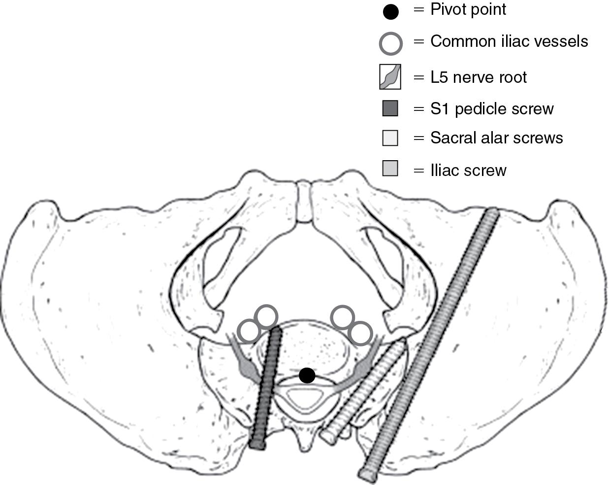 Fig. 30.1, Sacropelvic fixation options in relation to the lumbosacral pivot point and adjacent critical structures.