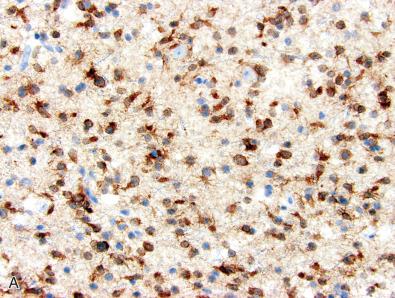 Fig. 5.1, Immunohistochemical detection of recurrent genetic alterations in CNS tumors using mutant-specific antibodies. (A) Diffuse astrocytoma in an adult that is positive for IDH1 R132H mutant protein immunostaining. (B) Diffuse astrocytoma in an adult that is negative for IDH1 R132H mutant protein immunostaining. This tumor instead harbored one of the less common IDH1 mutations (p.R132C) as detected by Sanger sequencing. (C, D) Ganglioglioma composed of large atypical ganglion cells and admixed neoplastic astrocytes. Immunostaining for BRAF V600E mutant protein shows staining predominantly in the ganglion cell component of the tumor with minimal positivity in the neoplastic glial cells. (E) Diffuse midline glioma centered in the pons of a child that is positive for histone H3 K27M mutant protein in tumor nuclei. (F) Diffuse glioma in the cerebral hemisphere of a child that is negative for histone H3 K27M mutant protein immunostaining, with nonspecific cytoplasmic staining seen in scattered activated microglia and macrophages.