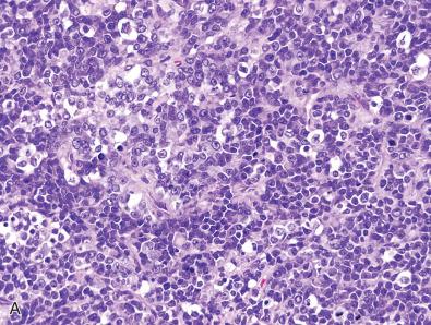 Fig. 5.2, Immunohistochemical detection of tumor suppressor proteins that are recurrently lost in CNS tumors. (A, B) Atypical teratoid/rhabdoid tumor demonstrating somatic loss of SMARCB1/INI1 protein expression in tumor cells, with intact expression in non-neoplastic endothelial cells providing an internal positive control. This finding is very suggestive of biallelic SMARCB1 gene deletion or mutation in the tumor cells. (C, D) Medulloblastoma with extensive necrosis demonstrating absence of SMARCB1/INI1 staining in both tumor cells and endothelial cells and lymphocytes, which is suggestive of staining failure and not true loss of expression or SMARCB1 gene deletion or mutation.