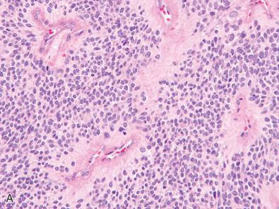 Fig. 5.4, Immunohistochemical assessment of genetic alterations in CNS tumors using antibodies against proteins or post-translational modifications that serve as surrogate markers. (A, B) Clear cell ependymoma located in the lateral ventricle of a child demonstrating strong membranous immunostaining for L1CAM protein. This finding is indicative of NF-kB pathway activation and is very suggestive that the tumor harbors RELA gene fusion. (C, D) Ependymoma centered in the fourth ventricle/posterior fossa of a child demonstrating absence of immunostaining for trimethylated lysine 27 of histone H3 (H3K27me3) in tumor cells with intact nuclear staining in non-neoplastic endothelial cells. This loss of H3K27me3 is associated with the PFA molecular subgroup of posterior fossa ependymomas.