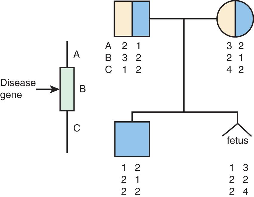 Fig. 94.1, Use of linkage analysis in prenatal diagnosis of an autosomal recessive disorder.