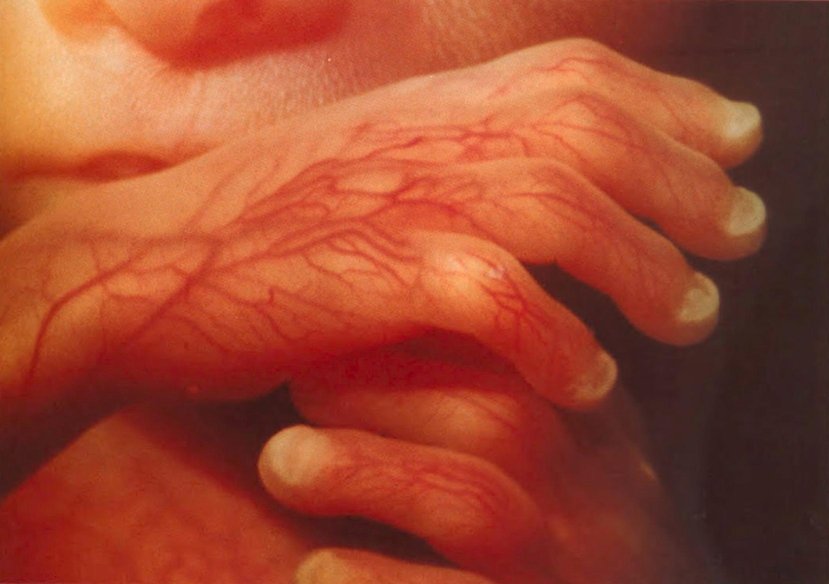 Fig. 9.12, Fetoscopy photo of 21-week fetus, showing the pattern of superficial veins on the hands and well-developed fingernails.