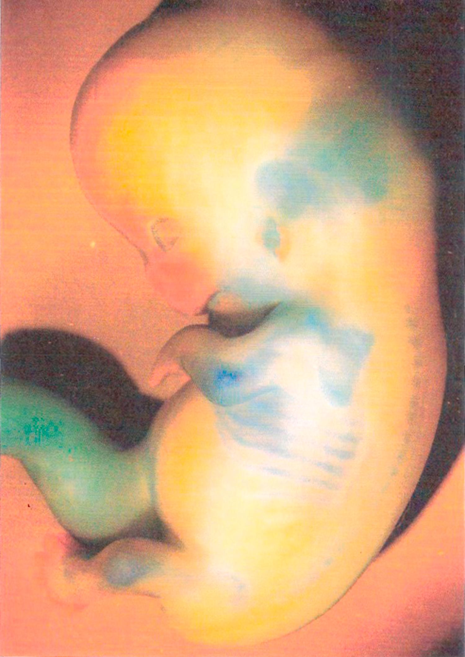 Fig. 9.19, A 51- to 52-day fetus with cartilage stained blue.