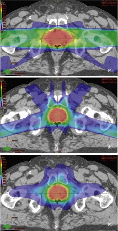 Figure 45.1, Comparison of Dose Distribution for 3D-CRT, IMRT, and VMAT.