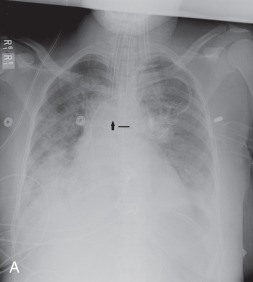 Figure 39.1, (A) Portable chest radiograph demonstrates the endotracheal tube tip approximately 2 cm above the carina (arrow), which is at the level of T5 ( black line denotes inferior endplate of T5). A nasogastric tube is also noted within the stomach. A left subclavian dual-lumen chest port has its tip at the superior cavoatrial junction. Cardiomegaly, pulmonary edema, pleural effusions, and nonspecific basilar consolidation suggest congestive heart failure. (B) Advancement of the endotracheal tube into the right main stem bronchus results in left lung atelectasis.