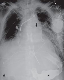 Figure 39.2, (A) Portable chest radiograph demonstrating a dual-chamber endotracheal tube with the left-sided tube in the left main stem bronchus (arrow) and the right-sided tube above the right main stem bronchus orifice. A left ventricular assist device is present (asterisk). Automatic implantable cardioverter-defibrillator leads are in the right atrial appendage and right ventricular apex. A right chest tube is directed toward the right apex. (B) This portable chest radiograph demonstrates a left-sided chest tube outside the pleural space with a persistent left pneumothorax.