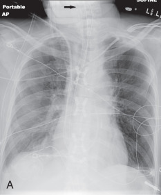 Figure 39.3, (A) Portable chest radiograph demonstrating a nasogastric tube coiled in the hypopharynx (arrow). The endotracheal tube tip is above the carina. A Swan-Ganz catheter is within the main pulmonary artery. Bilateral chest tubes are present. (B) Portable chest radiograph demonstrating a Dobhoff feeding tube entering the right main stem bronchus. (C) Portable chest radiograph demonstrates a nasogastric tube entering the left lung. This resulted in injury to the airway and a left pneumothorax.