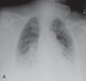 Figure 39.4, (A) Portable chest radiograph showing the left jugular venous catheter approximately 1 cm cranial to the level of the aortic arch, lateral and below the expected location of the left jugular vein and likely extravascular. (B) Noncontrast CT confirms the extravascular position of the central venous catheter. (C) Contrast-enhanced CT in a different patient shows a hematoma in the anterior mediastinum due to an extravascular venous catheter.